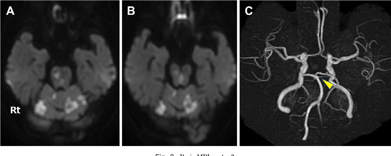 Figure 1 from Wall-eyed bilateral internuclear ophthalmoplegia ( WEBINO ... Figure 1 from Wall-eyed bilateral internuclear ophthalmoplegia ( WEBINO ...