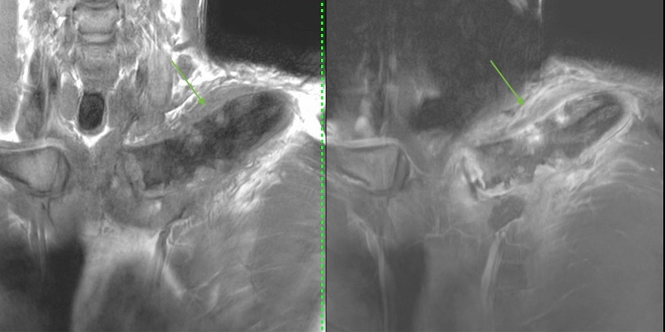 Case 16: A Swollen Clavicle