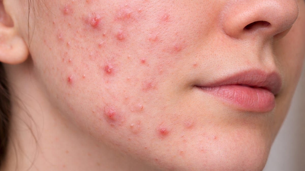 Why I Ask My Acne Patients About Their Diet