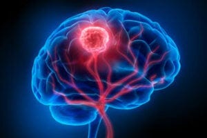 Brain and tumor illustration. Courtesy of nottingham.ac.uk