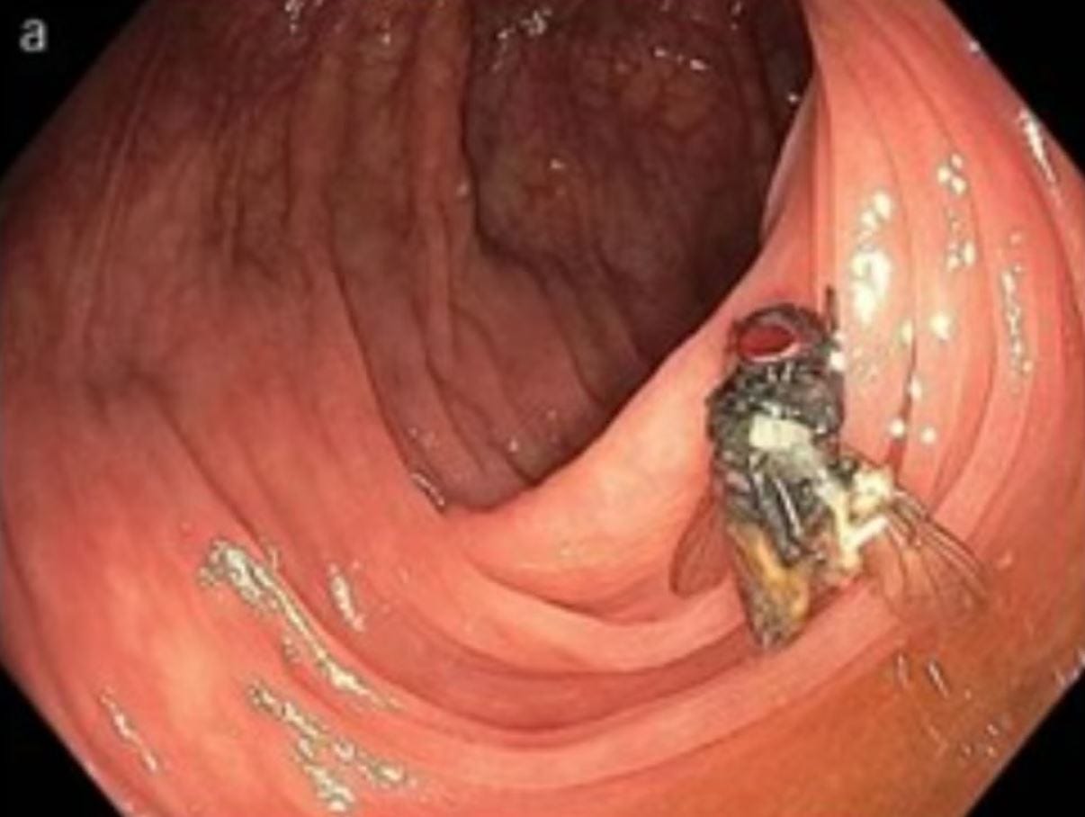 Os médicos encontraram uma mosca viva no intestino de um paciente. Os médicos encontraram uma mosca viva no intestino de um paciente.