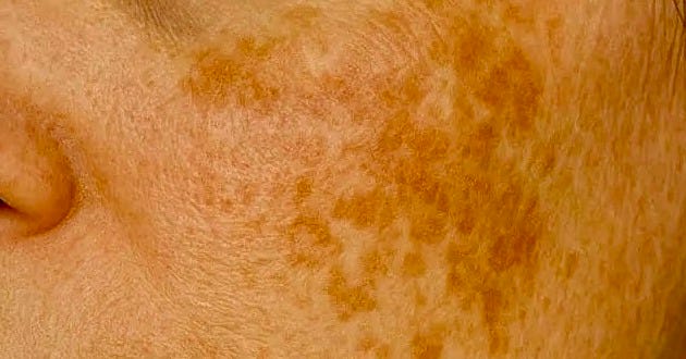 Your melasma serum isn't working. Here's why.