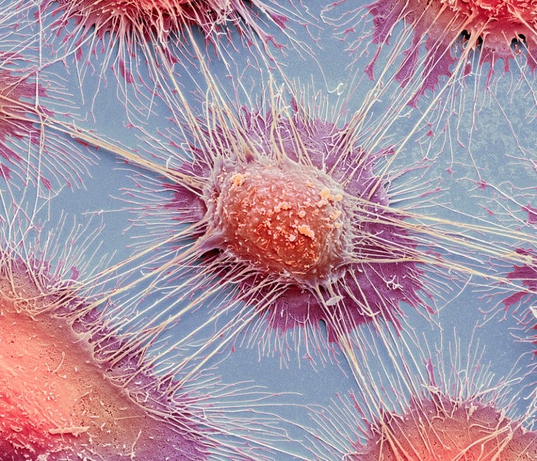 Coloured scanning electron micrograph of squamous cell carcinoma cells from a human mouth. Coloured scanning electron micrograph of squamous cell carcinoma cells from a human mouth.