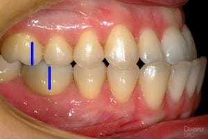 Bite Classification, Petaluma Orthodontics, Petaluma, CA
