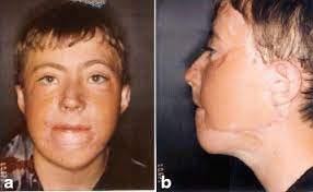 Aesthetic reconstruction of the severely disfigured burned face: a creative  strategy for a “natural” appearance using pre-patterned autogenous free  flaps | Burns & Trauma | Full Text