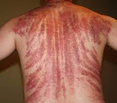 File:Gua Sha Massage Aftermath.jpg - Wikimedia Commons
