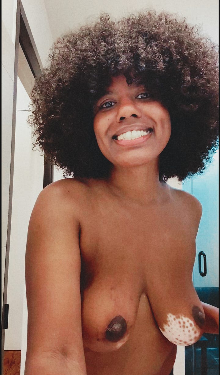 Left image: A close-up, topless portrait of a smiling woman with a large, dark, voluminous afro and dark skin. She has wide, bright eyes and is looking directly at the camera. Her areolas are dark brown, and the left breast has several patches of lighter, depigmented skin, possibly due to vitiligo, extending from the bottom of the areola. The background is a brightly lit, modern bathroom. Right Image: A head-and-shoulders, topless photo of a middle-aged man with pale skin, a partially bald head, and silver-rimmed glasses, smiling slightly at the camera. He is wearing a short, multicolored beaded necklace featuring tan, brown, and turquoise beads. He is in an outdoor hot tub, with the metallic grey side of the tub and a white awning visible in the background against a cloudy sky.