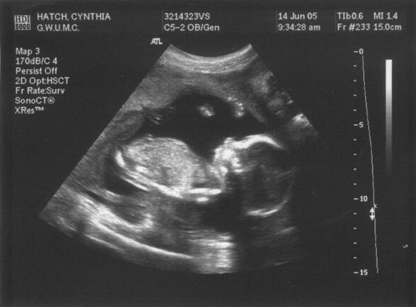 Everything was on track for a normal birth. Everything was on track for a normal birth.