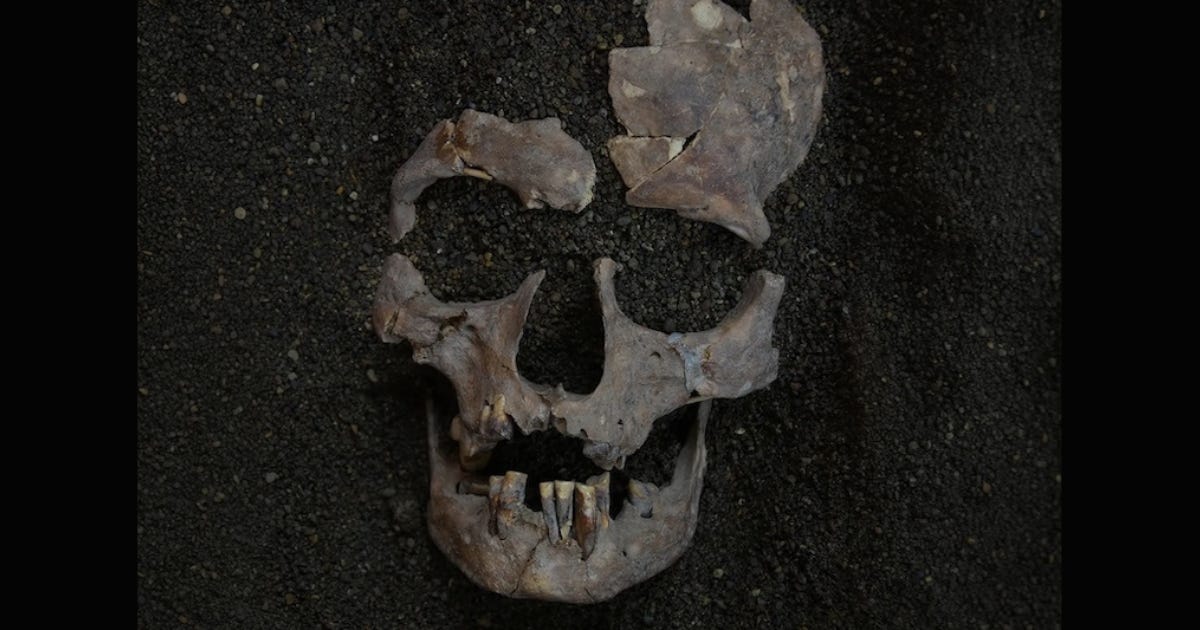The skull of one of the two foragers from Sulawesi, showing the heavy dental wear the researchers attribute to years of holding whole betel nuts in the mouth. The skull of one of the two foragers from Sulawesi, showing the heavy dental wear the researchers attribute to years of holding whole betel nuts in the mouth.