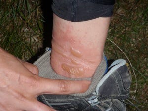 ankle blisters