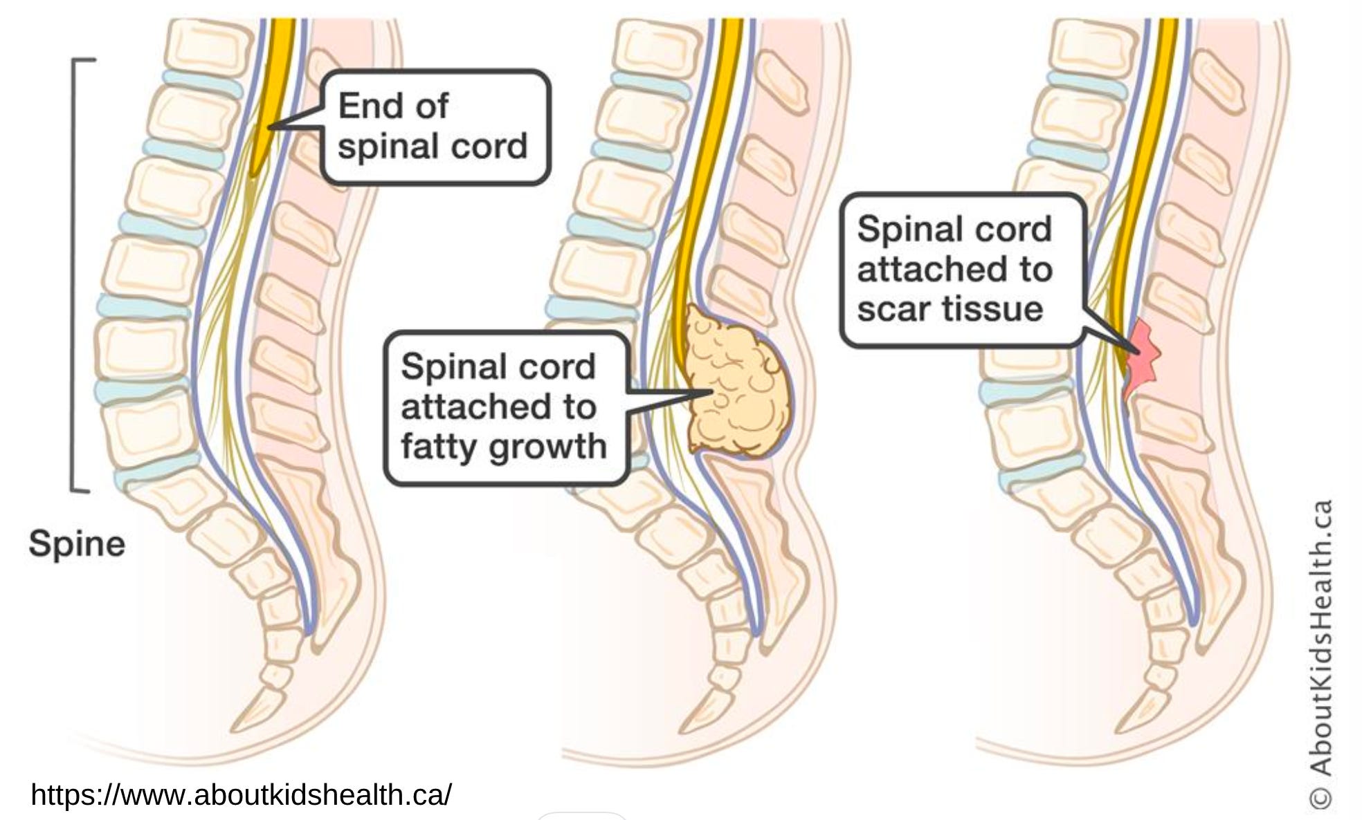 Ed's Dislocation Neurological Manifestations of EDS