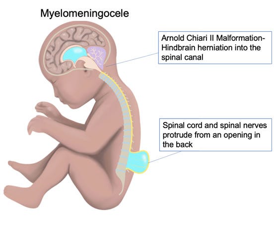 Open Spina Bifida / Myelomeningocele - Los Angeles Fetal Surgery