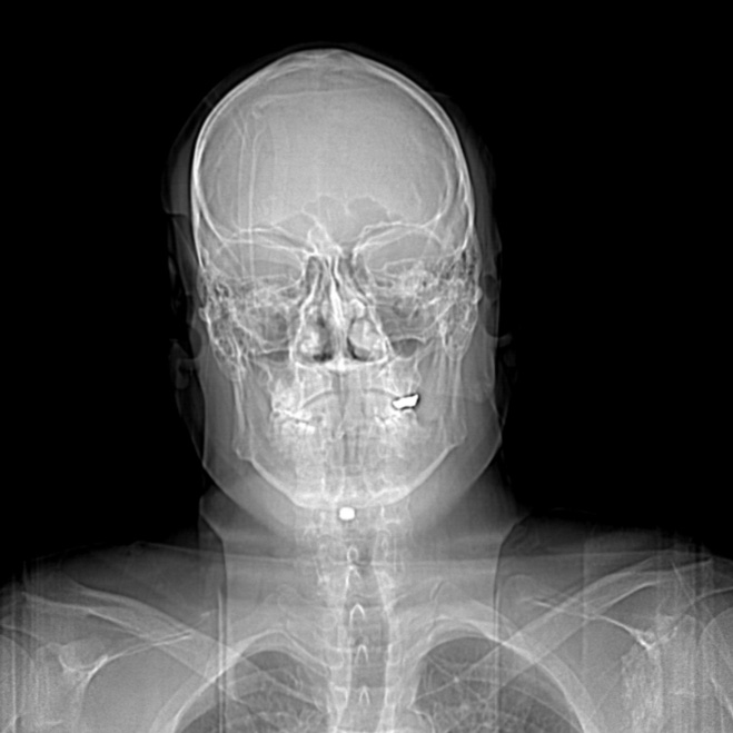 Cervical spine and skull X-ray, used humorously to illustrate the ongoing medical uncertainty and cost behind chronic pain