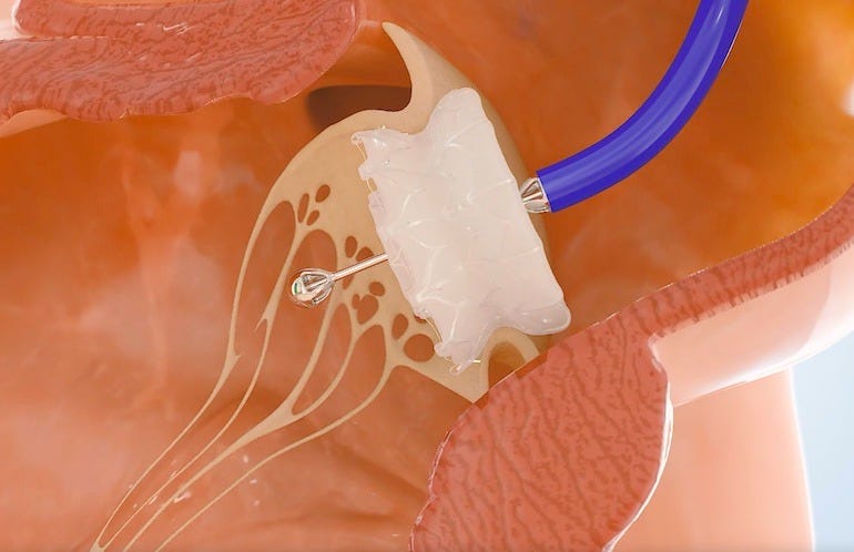 Capstan Medical has developed a catheter-based treatment for cardiac valve conditions.