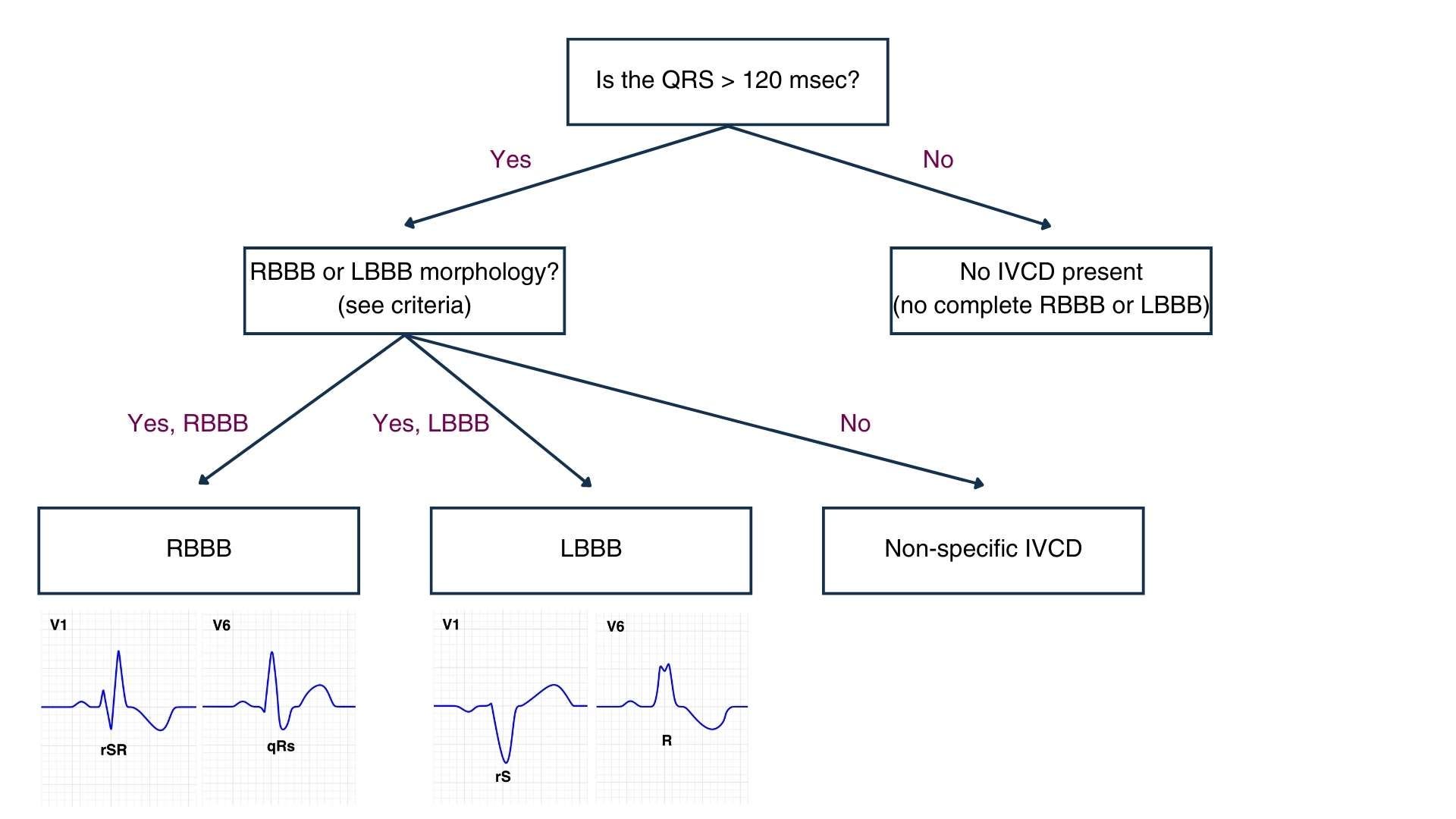 Bundle branch blocks (forget William Marrow)