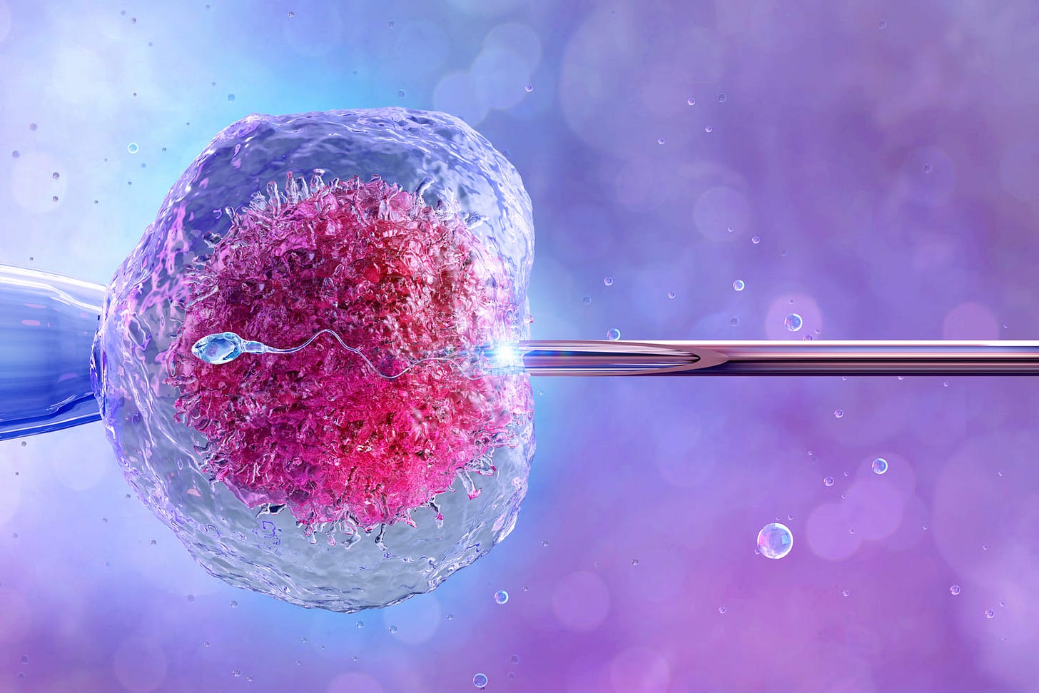 IVF procedure