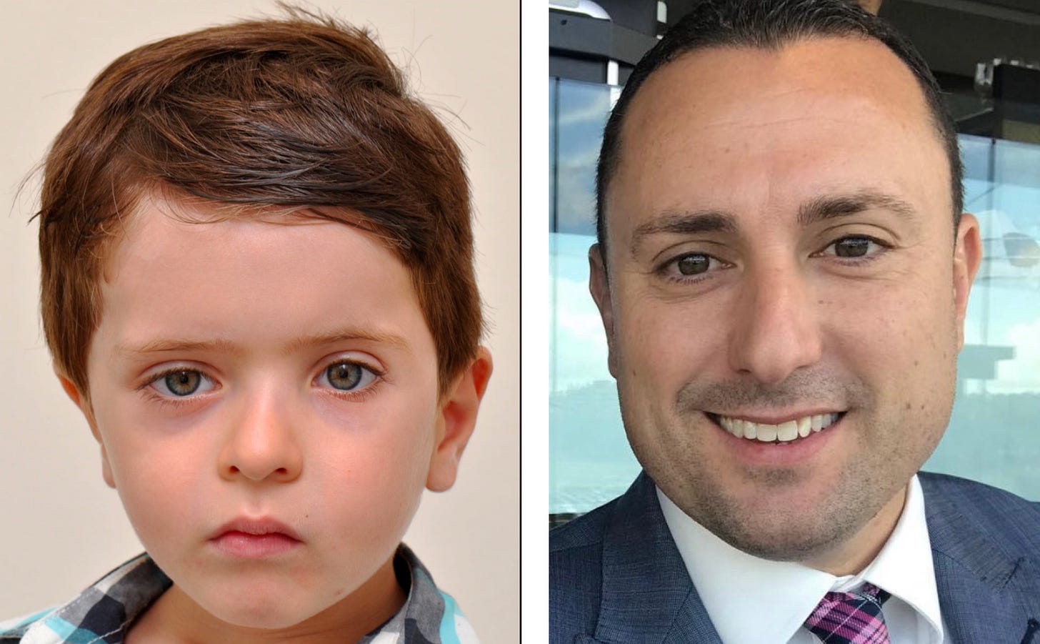 Before and after comparison showing correction of facial asymmetry and eye alignment reflecting improved brainstem motor control and primitive reflex integration