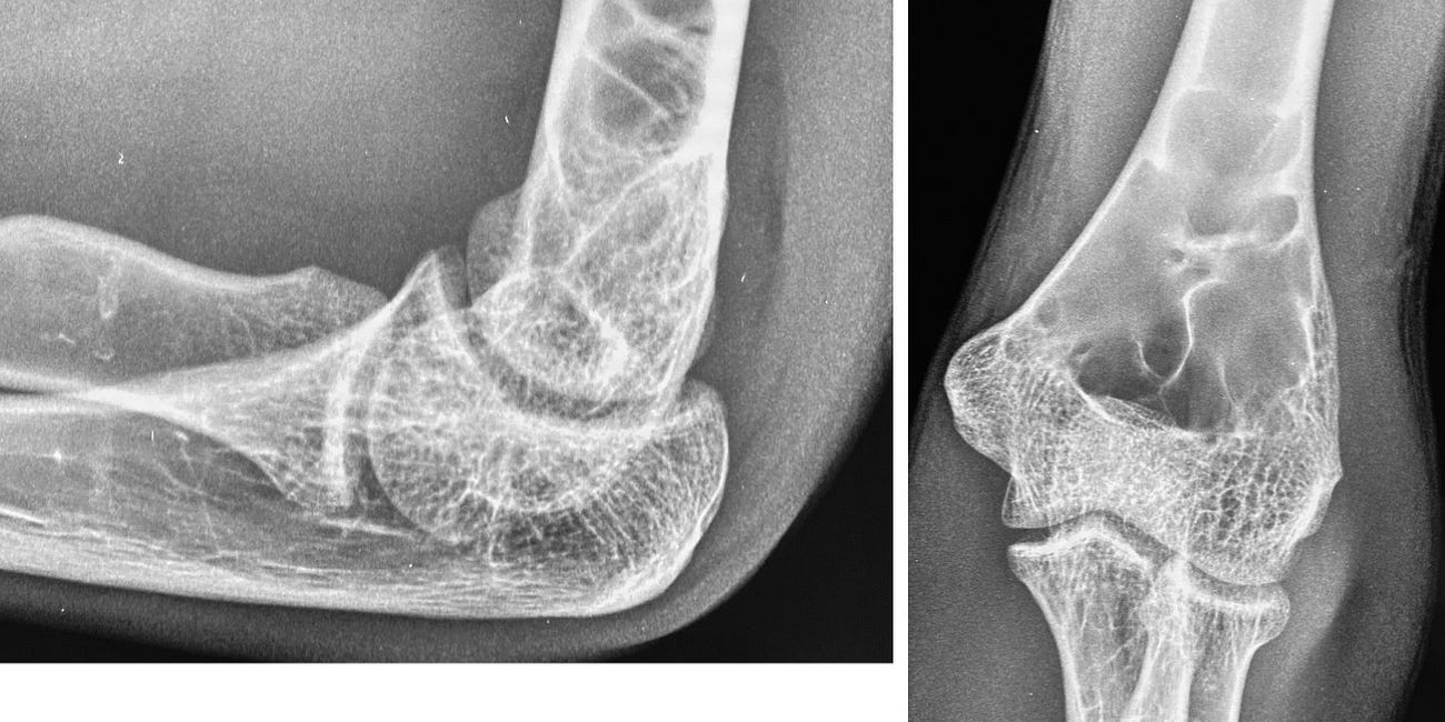 Case 24: A Soapy Humerus