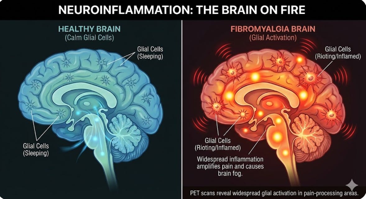 glutathione and fibromyalgia 2: Your Brain is on Fire (Literally) anti-aging-whitening-body-lotion Tirzepatide Weight Loss Houston Quantity:10 Vials