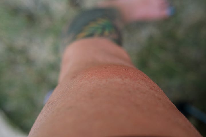 Welts and swelling on my legs from wasp stings