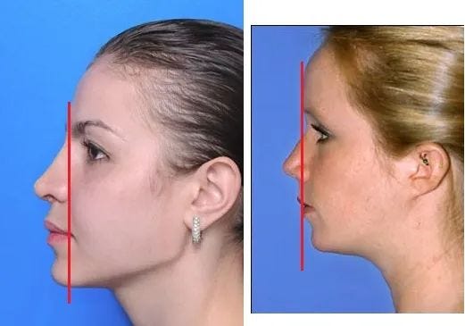 Notice how the woman on the left has a very forward mandible and her lips  and nose project outwards much more. Also, her brow ridge and nose form a  sloped curve…
