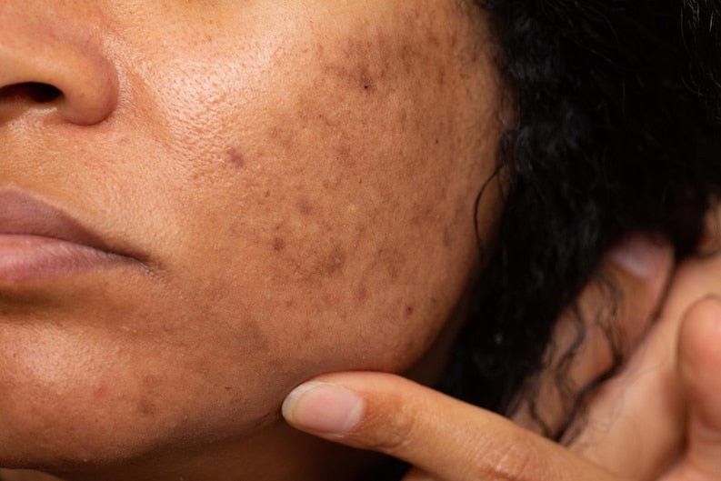 Why Do I Get Hyperpigmentation? Treatment, Causes, and Prevention – Koji  White