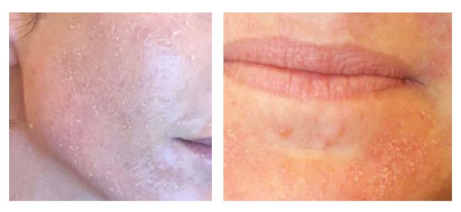 retinization process