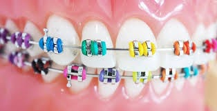 How To Choose The Color Of Your Braces ...