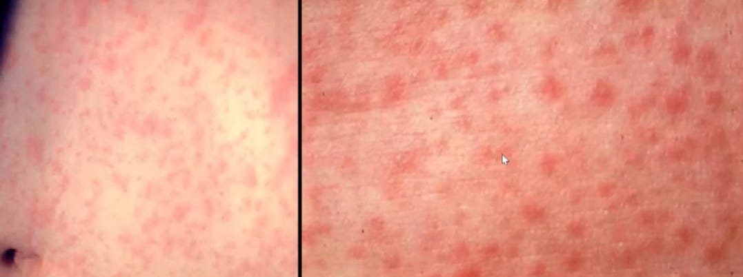 Hong Kong Reports First Measles Case of 2024 | Outbreak News Today