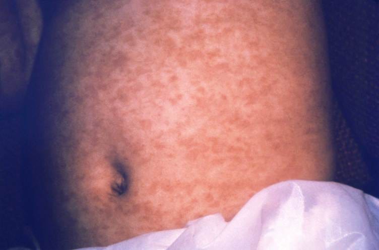 A child’s stomach is uniformly covered in small, tightly packed reddish brown patches. A child’s stomach is uniformly covered in small, tightly packed reddish brown patches.