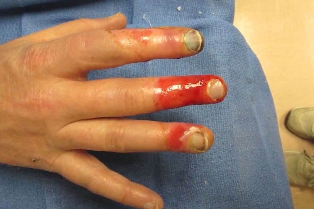 One fan, who only took their gloves off for five minutes to set up a tent in the parking lot, was left with red fingertips.