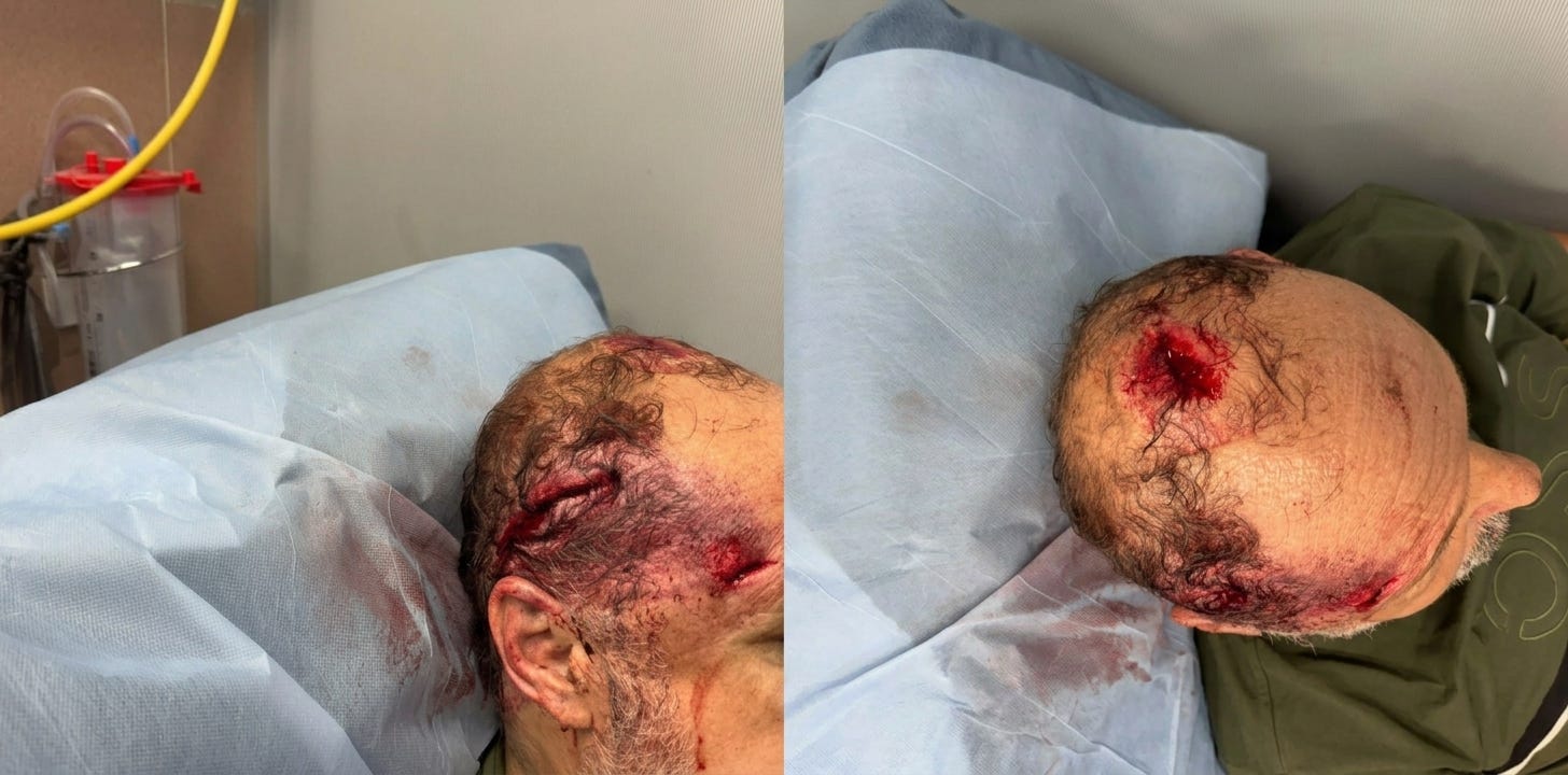 🚨 WEST BANK ALERTS — Escalating Vigilante Violence: Palestinian-American Haitham Tayseer Brutally Attacked by Settlers in Burqa Olive Groves