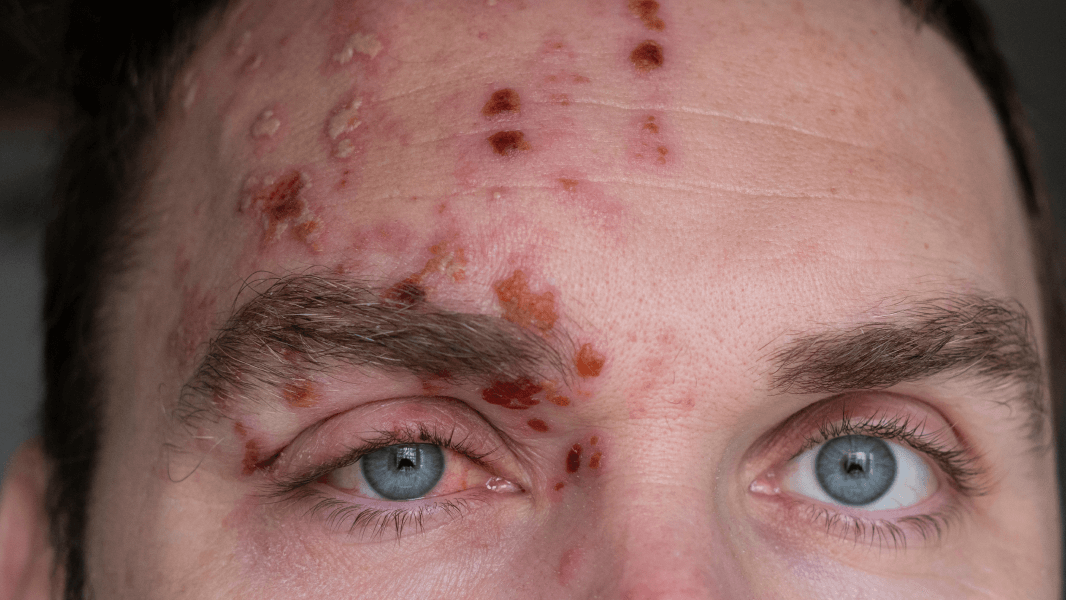 Q&A 92: shingles on ocrelizumab - by Gavin Giovannoni Q&A 92: shingles on ocrelizumab - by Gavin Giovannoni