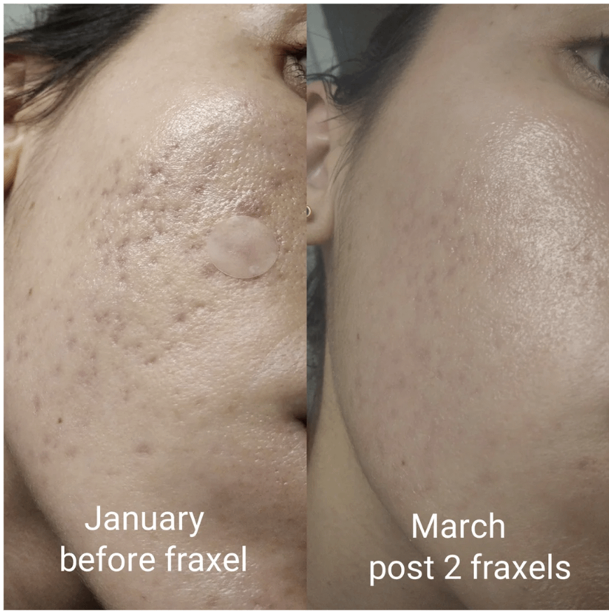 r/30PlusSkinCare - My Guide to Cosmetic Lasers and Laser Skin Resurfacing