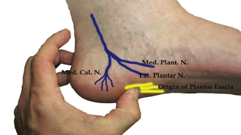 Baxter's Nerve Entrapment - Diagnosis, Treatment, Injection, Surgery Baxter's Nerve Entrapment - Diagnosis, Treatment, Injection, Surgery