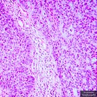 Moderna Injects First Participant With Experimental mRNA-4200 Cancer Shot That Forces the Body to Produce Seven Undisclosed Tumor Proteins