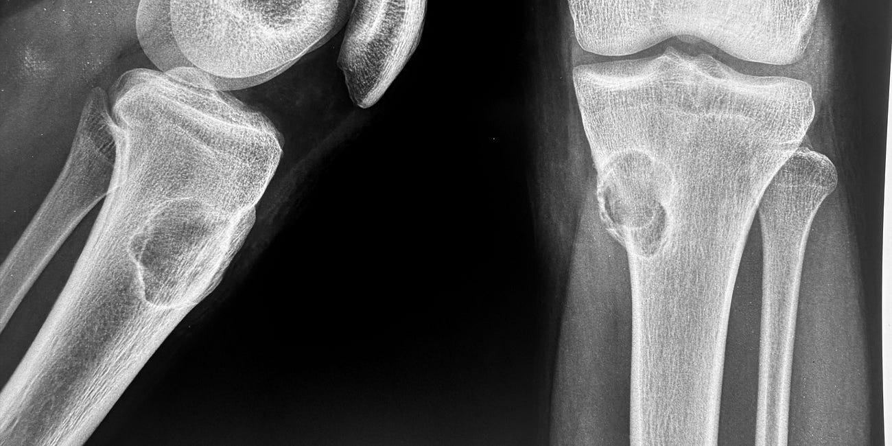 Case 56: A Benign Aggressive Tibial Lesion