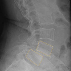 Each spinal curve is unique, and why you should know yours