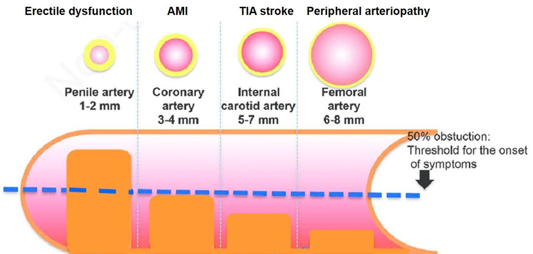 Erectile Dysfunction: The Harbinger of Serious Cardiovascular Disease