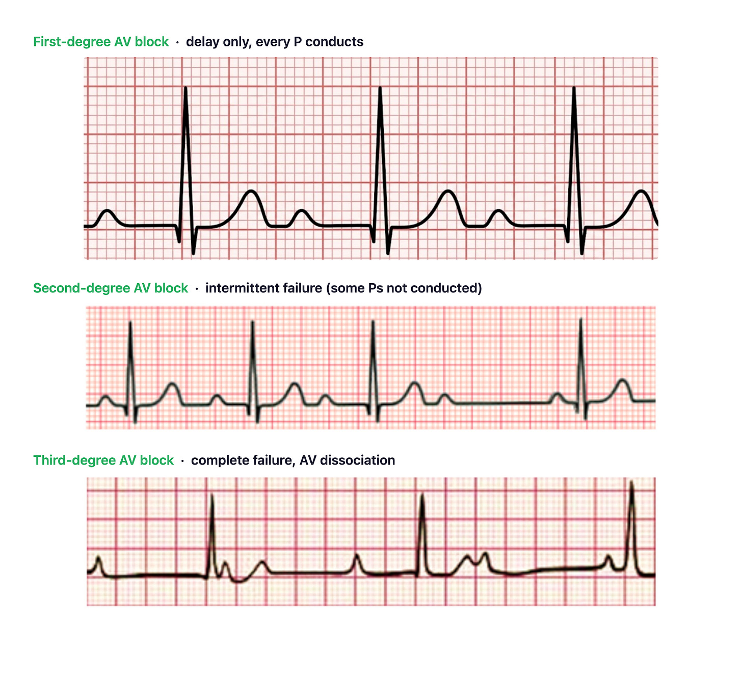 AV block spectrum on rhythm strips: first-degree (PR prolonged, all conducted), second-degree Mobitz I (progressive PR then dropped beat), and third-degree (P and QRS dissociated)