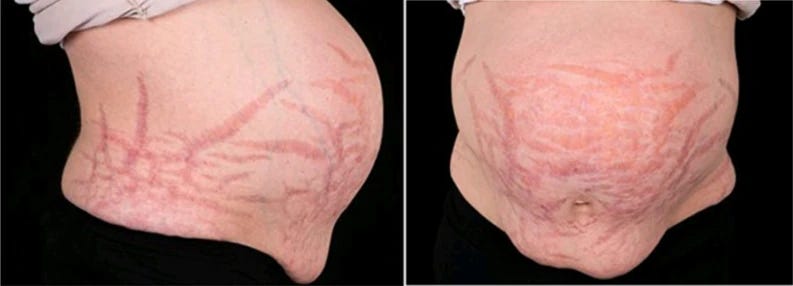 Pictures of an obese human abdomen, taken from front and side. An obvious feature is a multitude of wide, pink striae. Pictures of an obese human abdomen, taken from front and side. An obvious feature is a multitude of wide, pink striae.