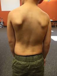 Treating Body Asymmetry with Postural ...