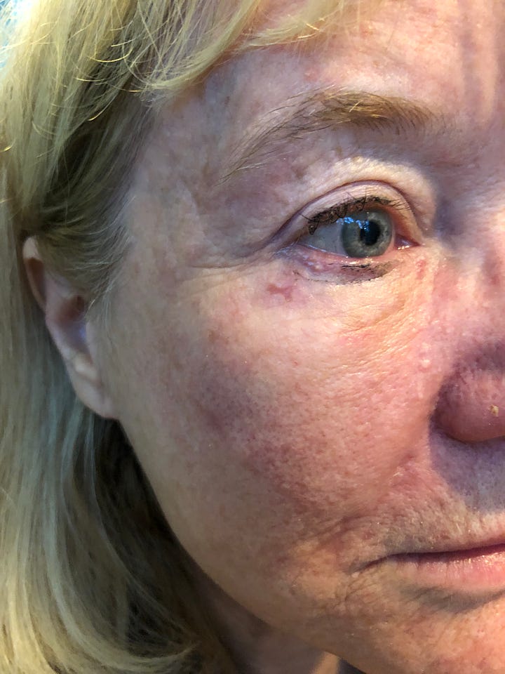 A Novel Approach for Resolution of Chronic Shingles and Postherpetic ...