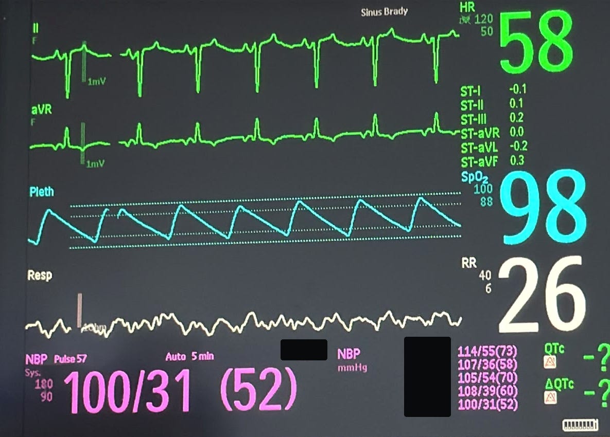 Registro intraoperatorio tardío desidentificado con un ritmo más organizado y bradicardia sinusal mostrada por el monitor. Documenta evolución temporal del trazado, sin permitir atribuirla a insulina, glucosa, calcio ni otra intervención.