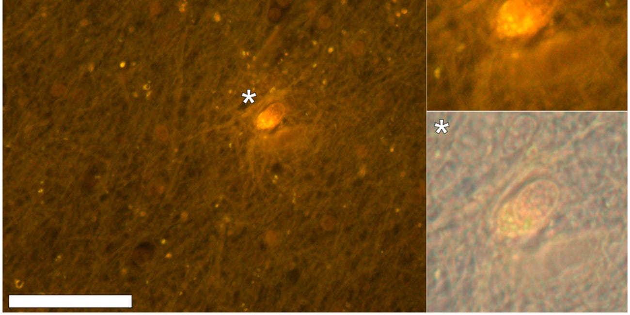 Aluminium and Autism: The Evidence