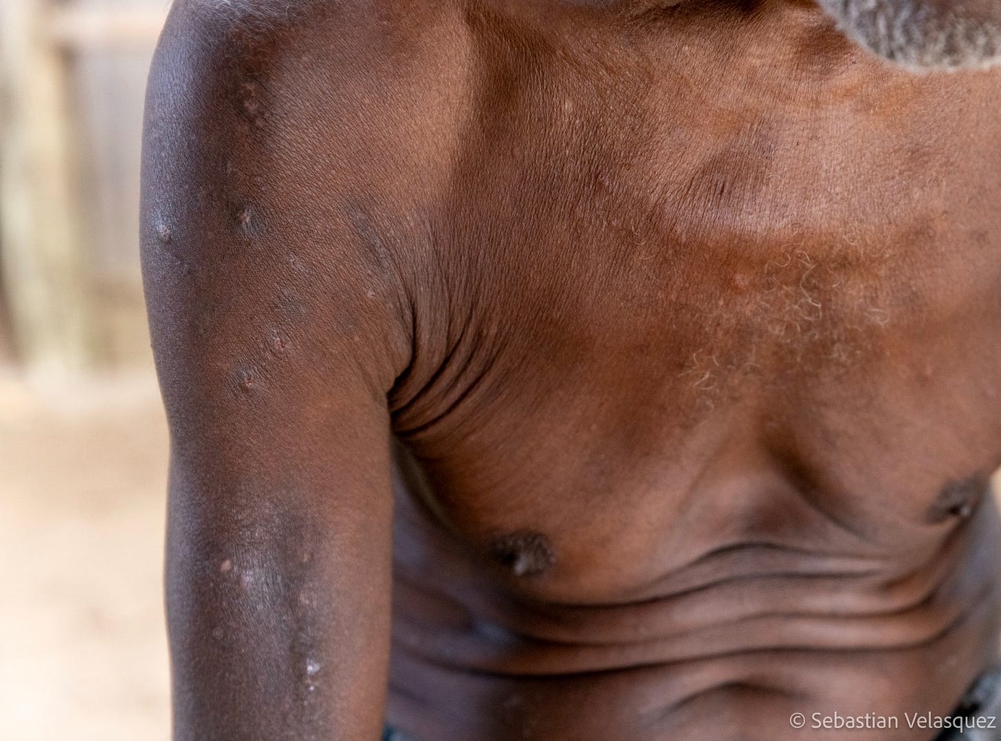 Skin irritations reportedly caused by recent contact with the waters off New Ireland’s east coast. Image ©Sebastian Velasquez. Skin irritations reportedly caused by recent contact with the waters off New Ireland’s east coast. Image ©Sebastian Velasquez.