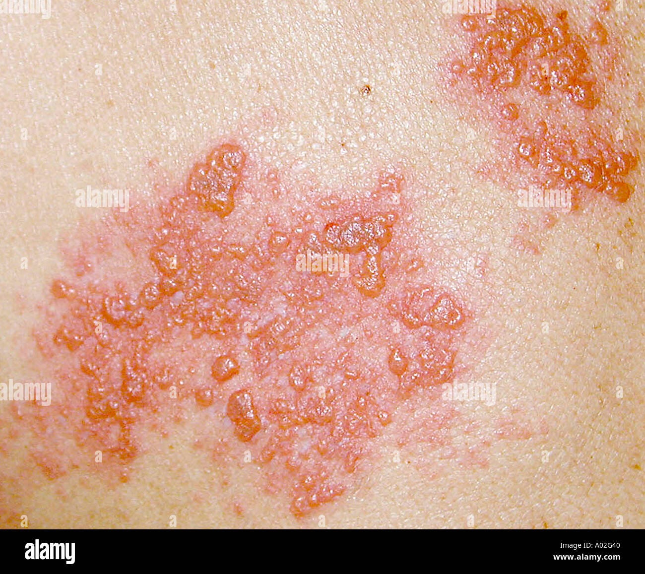 https://c8.alamy.com/compde/a02g40/herpes-zoster-gurtelrose-hautausschlag-a02g40.jpg
