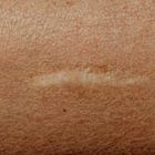 The Scar