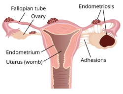 Endometriosis - Wikipedia