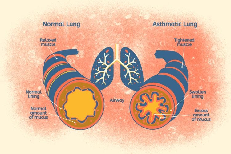 Asthma